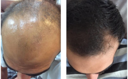 مقاله آموزش چگونگی تجویز محلول رویش مو و توقف کامل ریزش موی دکتر نوروزیان